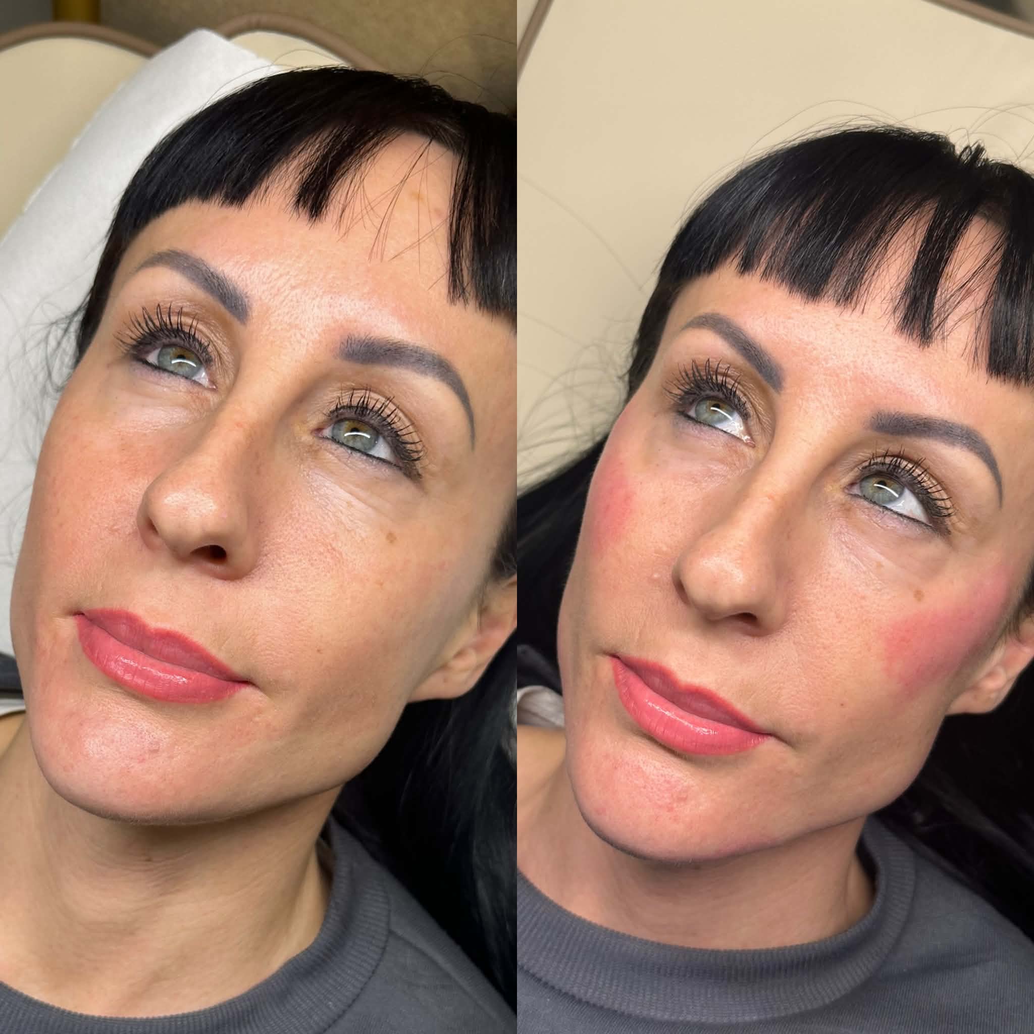 Cheek Filler