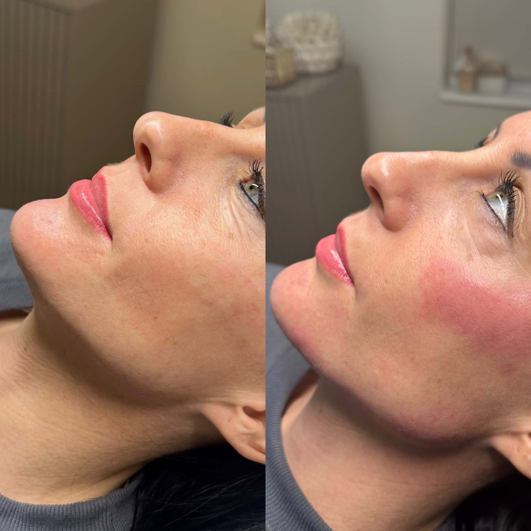 Chin Filler
