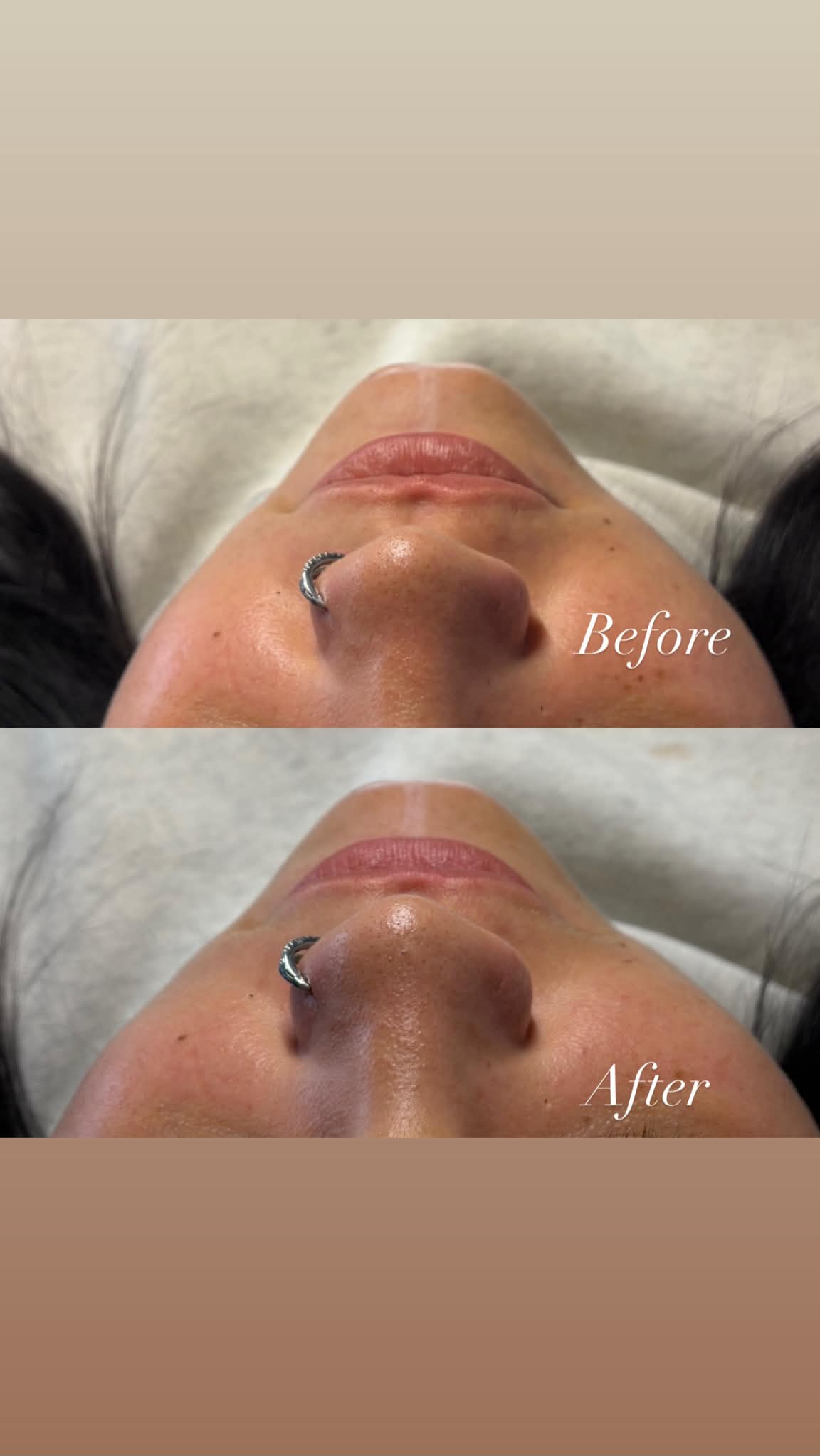 Filler treatments